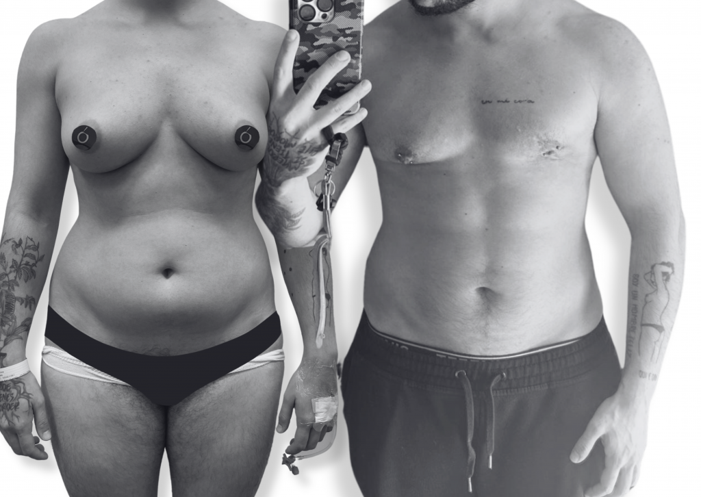 Mastectomía trans – resultado real