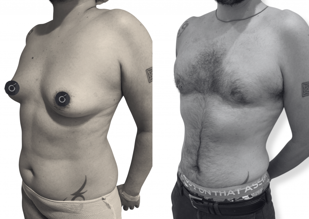 Mastectomía trans – resultado real