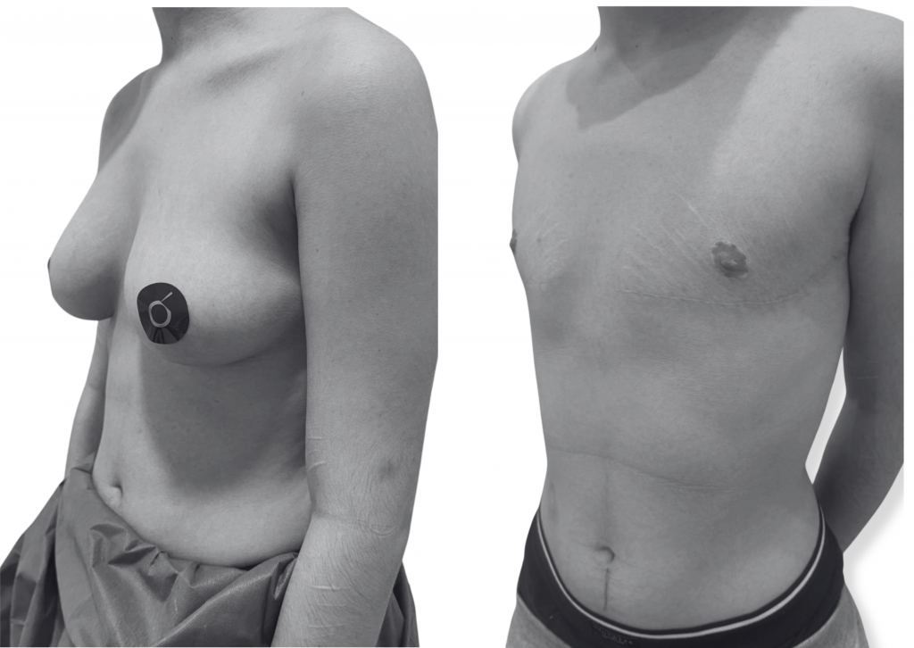 Mastectomía trans – resultado real