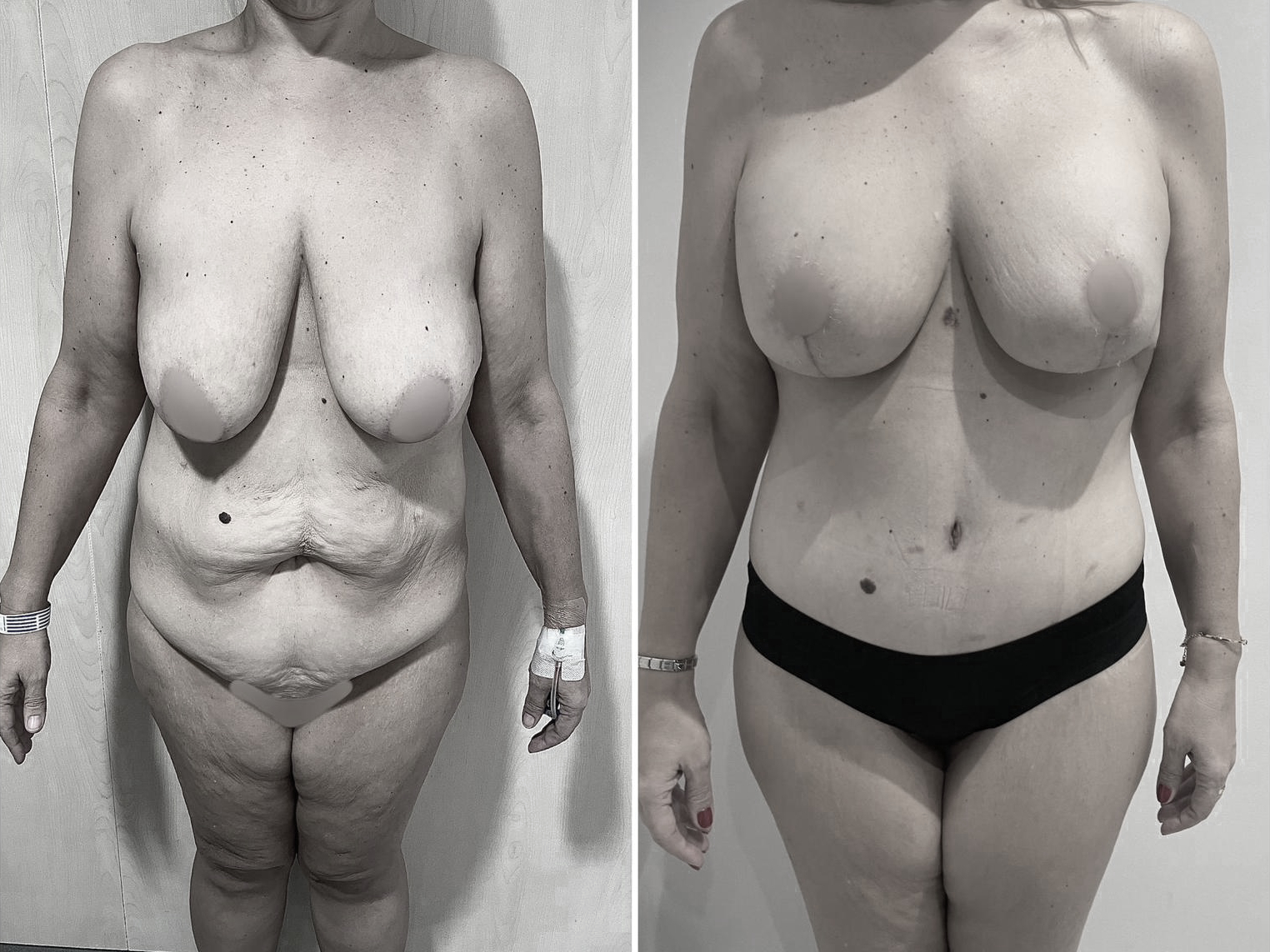 Cirugía postbariátrica de la Dra. Brasó, antes y después